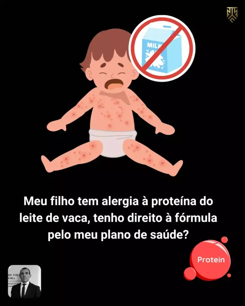 MEU FILHO TEM ALERGIA À PROTEÍNA DO LEITE DE VACA, TENHO DIREITO À FÓRMULA PELO MEU PLANO DE SAÚDE?